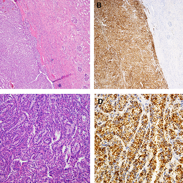 Team Led by Dr. Rohit Mehra discovers New Diagnostic Biomarker for Kidney Cancer