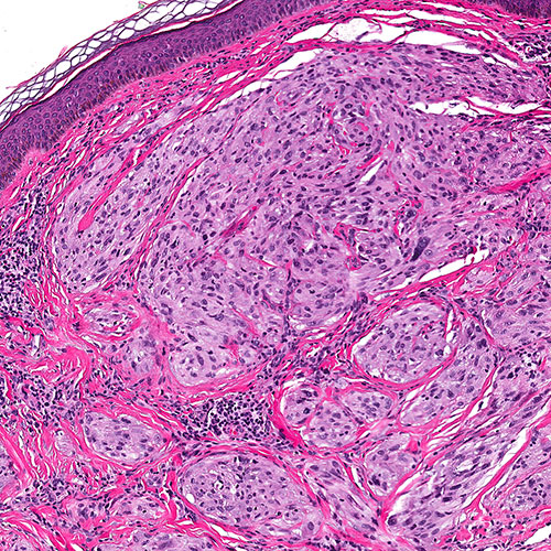 https://www.pathology.med.umich.edu/static/apps/cms/766/fig-11-nested-cellular-neurothekeoma-conventional-100x.jpg