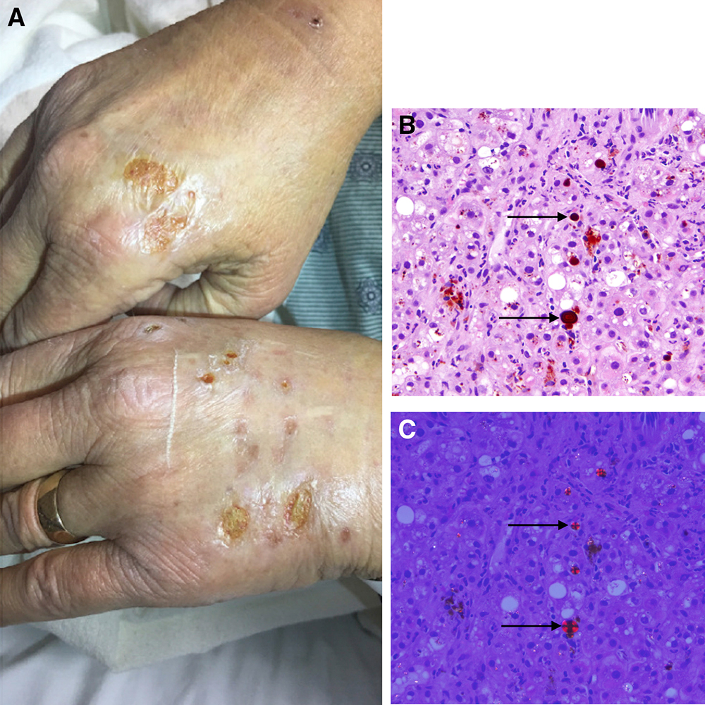 https://www.pathology.med.umich.edu/static/apps/cms/816/Westerhoff-Rare-Complication.jpg