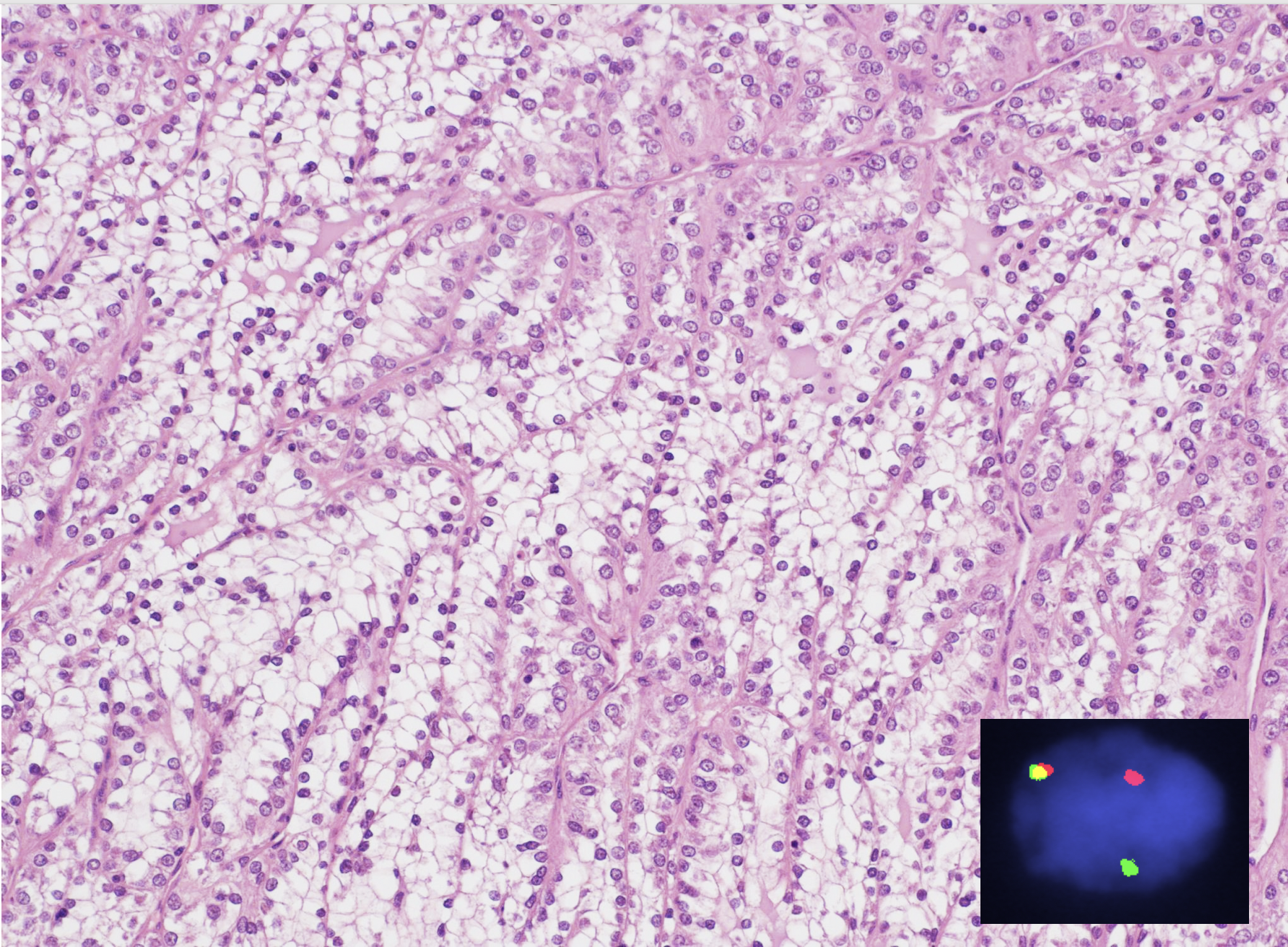 Accompanying picture shows a case of MiT family translocation RCC in a young patient; Inset image- FISH demonstrates TFE3 rearrangement; yellow = fusion (wild type) and red/green = break-apart (rearranged).