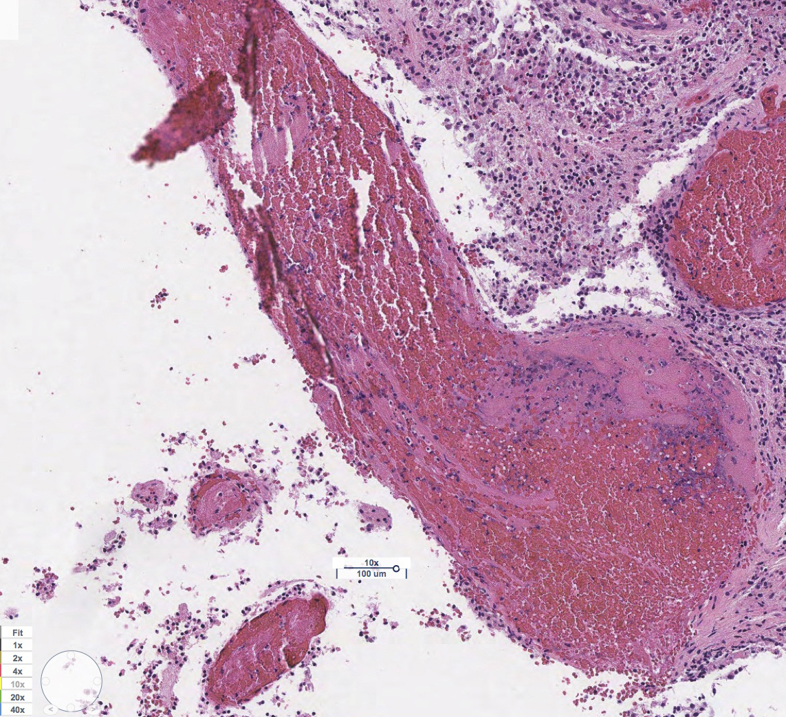 Blood vessel with a clot surrounded by hemorrhage within the tumor.