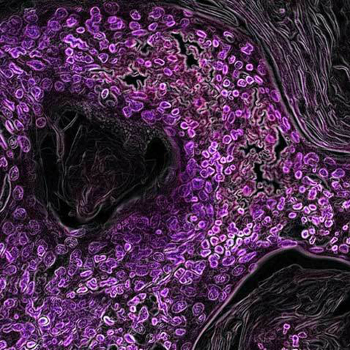 /static/apps/cms/news/1134/Lung-Cell-Microscopic-Cancer-Purple-500x500.jpg