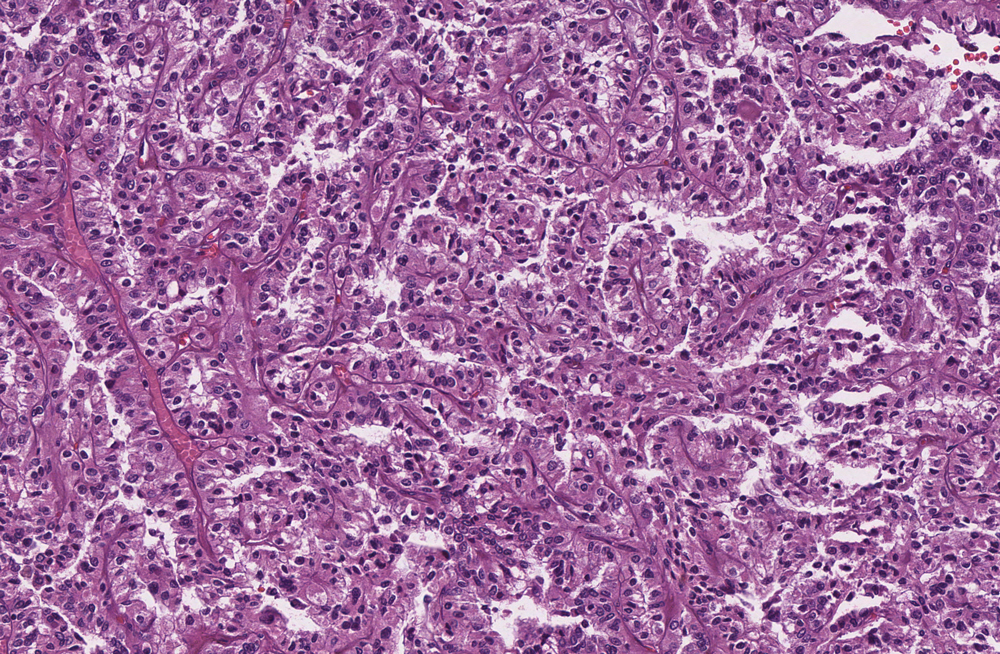 H&E image of a renal cell carcinoma with TFE3 translocation