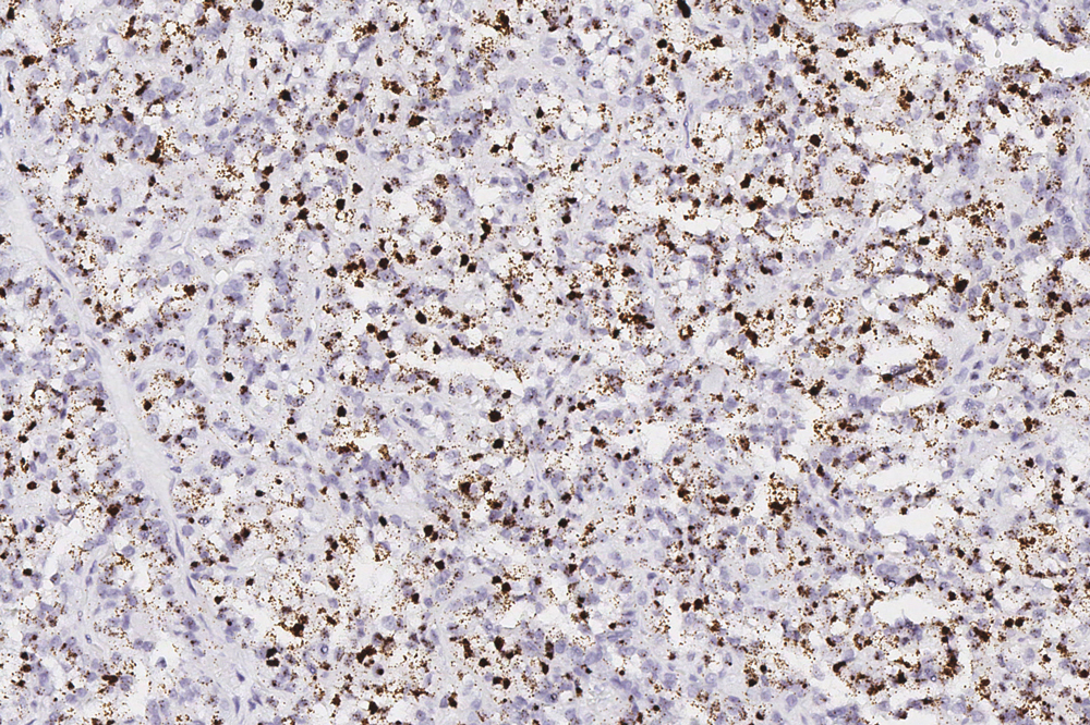 TRIM63 RNA-ISH image from this case showing strong, positive expression of this biomarker