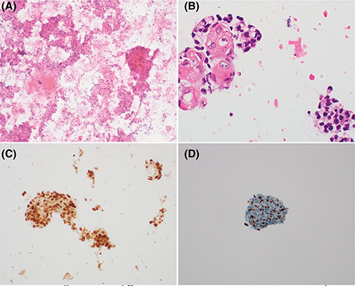 Squamous cell carcinoma differentiation in metastatic prostatic cancer to the mediastinal lymph node. Solid sheets of large tumor cells are present with necrosis (A) including prominent keratinization (B).  Prostate linear marker expression, such as NXK3.1 (C) was retained.  Ki-67 labeling index was elevated (D).