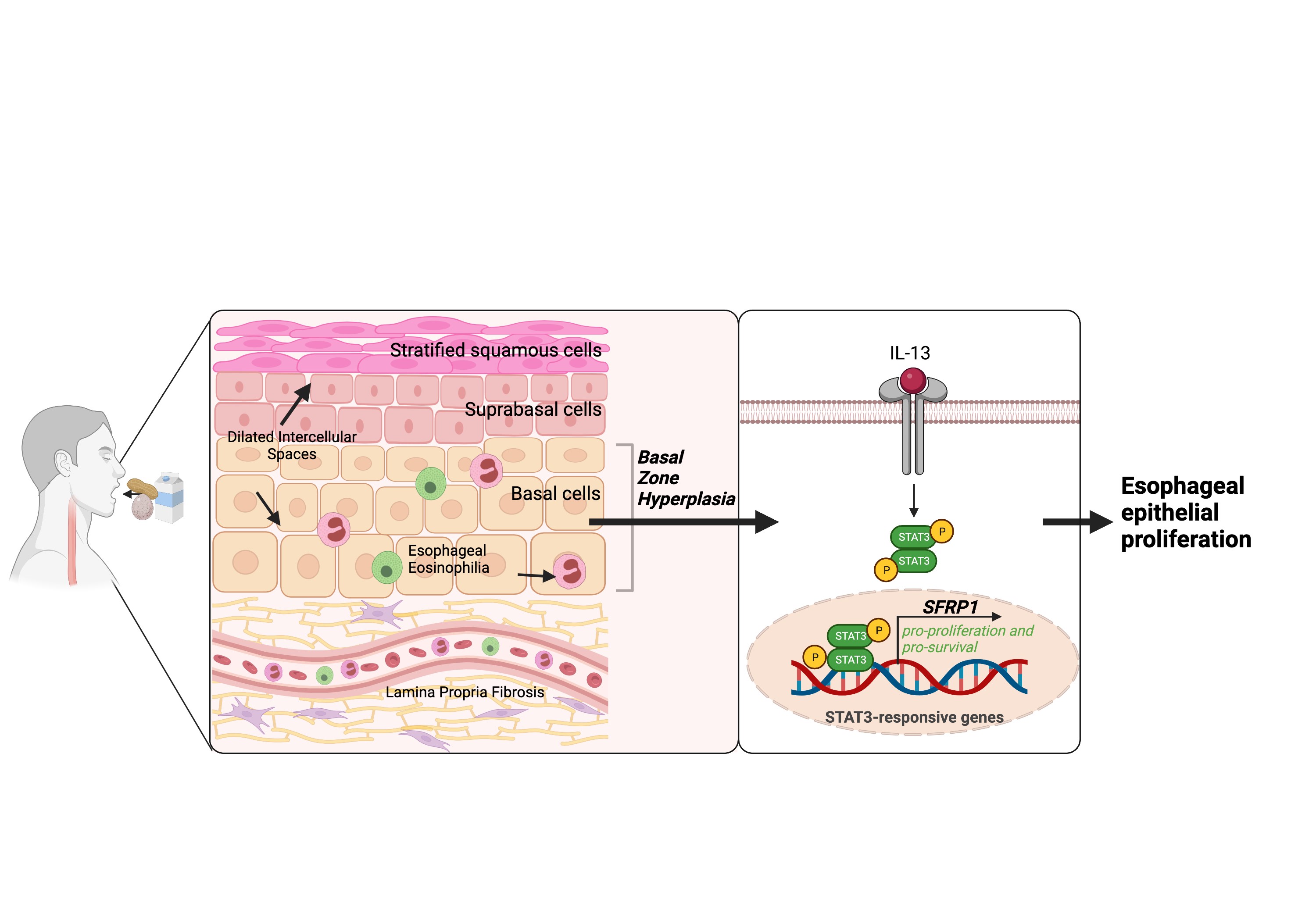 Food allergen induced EoE consists of esophageal epithelial proliferation and Basal Zone Hyperplasia, which are driven by an IL-13-induced STAT3 dependent SFRP1 expression. 