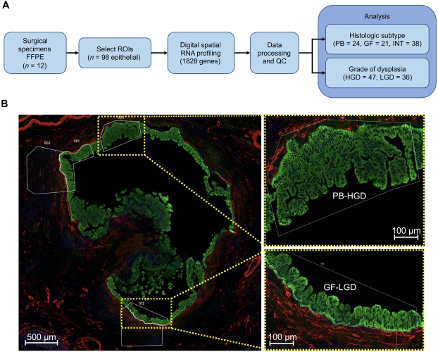 Spatial RNA profiling of intraductal papillary mucinous neoplasm.