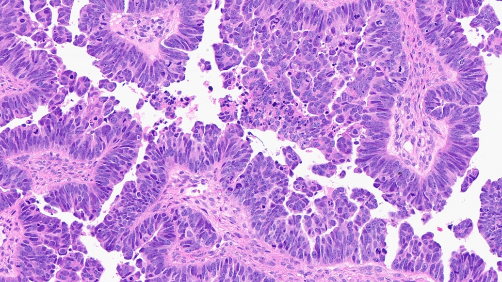 High-grade serous carcinoma. Credit: Kathleen Cho, M.D.